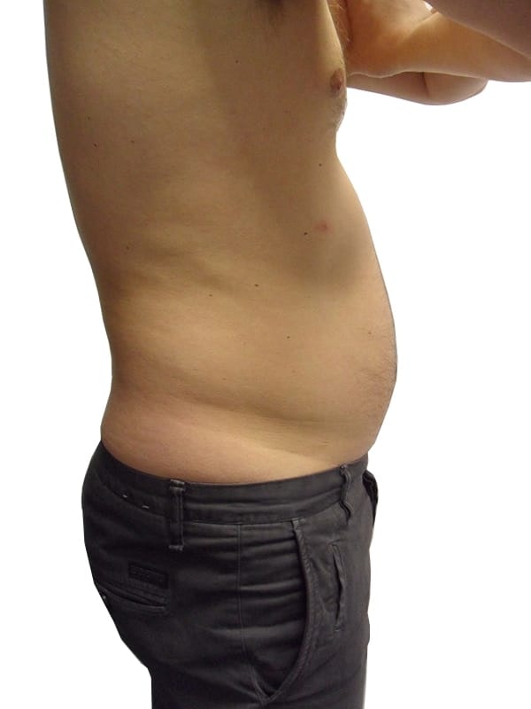 Liposuction men patient 8 - pre-op
