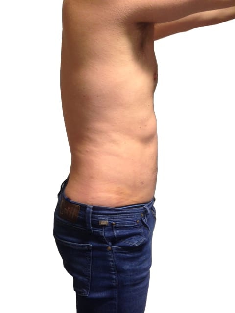 Liposuction men patient 8 - post-op