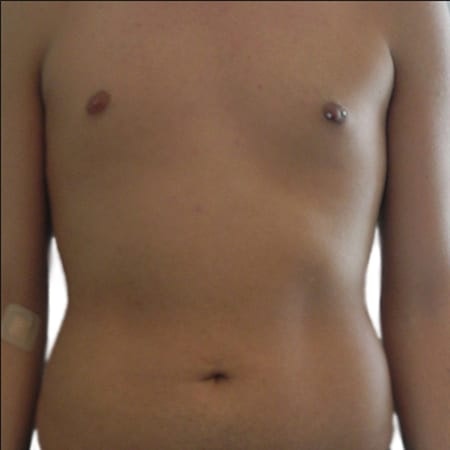 Liposuction men patient 7 - pre-op