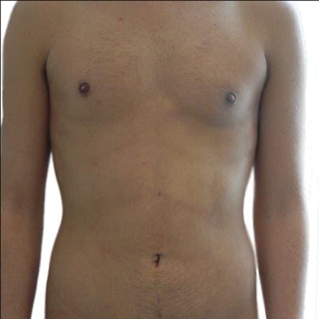 Liposuction men patient 7 - post-op