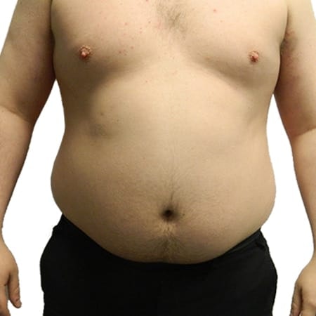Liposuction men patient 6 - pre-op