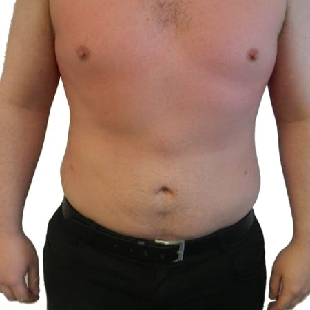 Liposuction men patient 6 - post-op