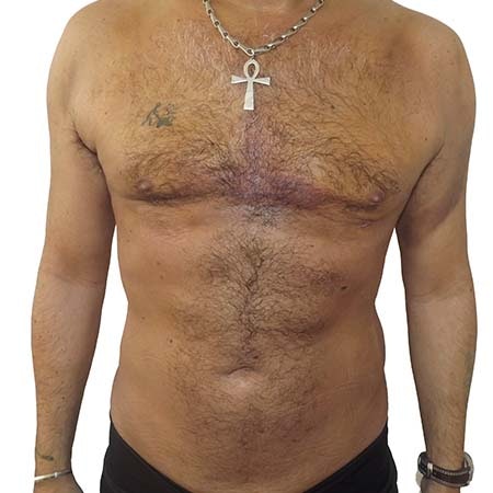 Liposuction men patient 5 - post-op