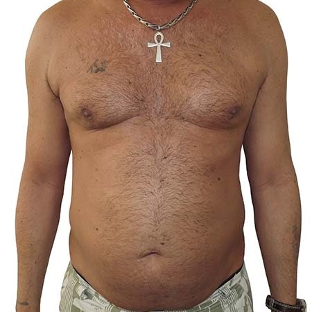 Liposuction men patient 5 - pre-op