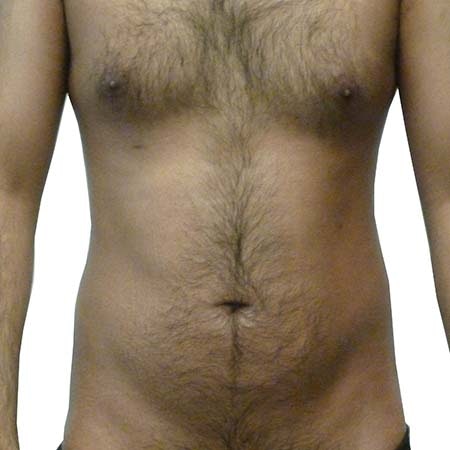 Liposuction men patient 4 - post-op