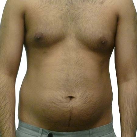 Liposuction men patient 4 - pre-op