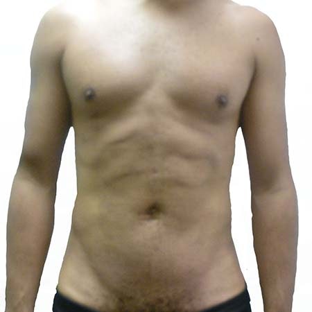 Liposuction men patient 3 - post-op