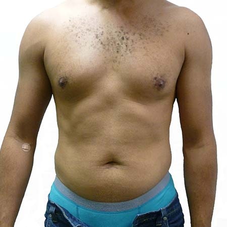 Liposuction men patient 3 - pre-op