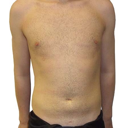 Liposuction men patient 1 - post-op