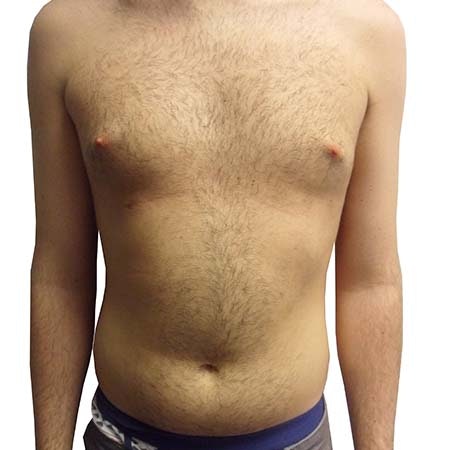 Liposuction men patient 1 - pre-op