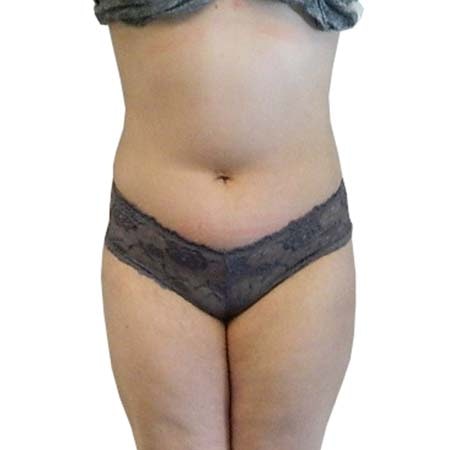 Liposuction patient 9 - post-op