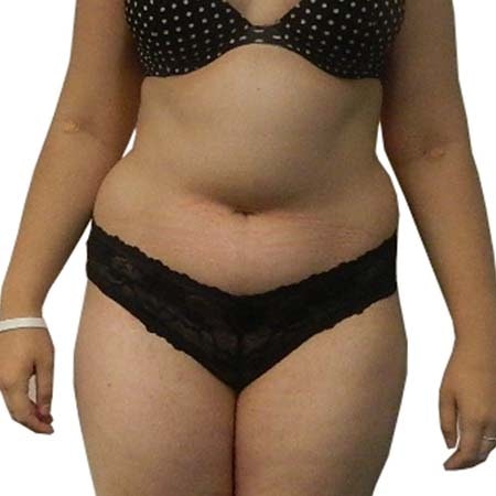 Liposuction patient 9 - pre-op