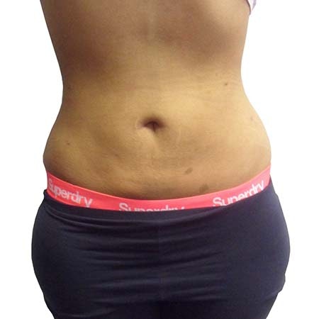 Liposuction patient 8 - post-op