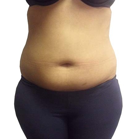 Liposuction patient 8 - pre-op
