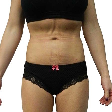 Liposuction patient 7 - post-op