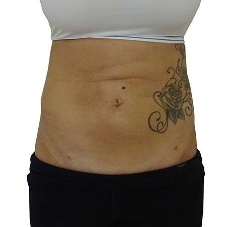 Liposuction patient 6 - post-op