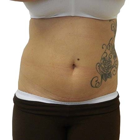 Liposuction patient 6 - pre-op