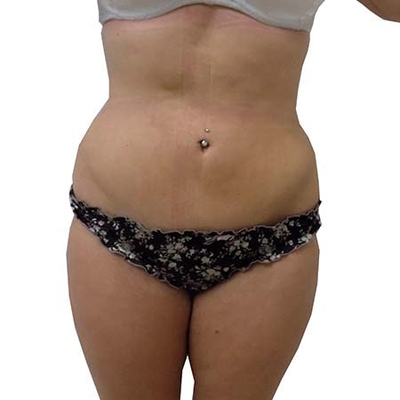 Liposuction patient 5 - post-op