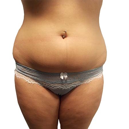 Liposuction patient 5 - pre-op