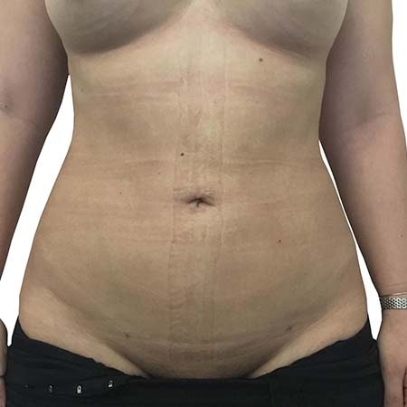 Liposuction patient 4 - post-op