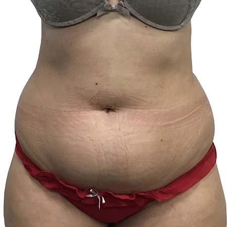 Liposuction patient 4 - pre-op