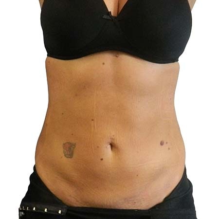 Liposuction patient 3 - post-op