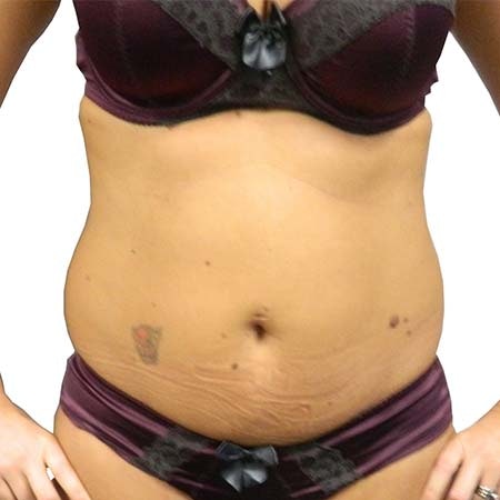 Liposuction patient 3 - pre-op