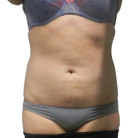 Liposuction patient 2 - post-op
