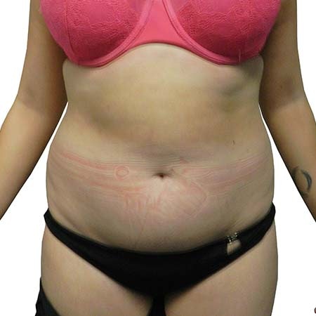 Liposuction patient 2 - pre-op