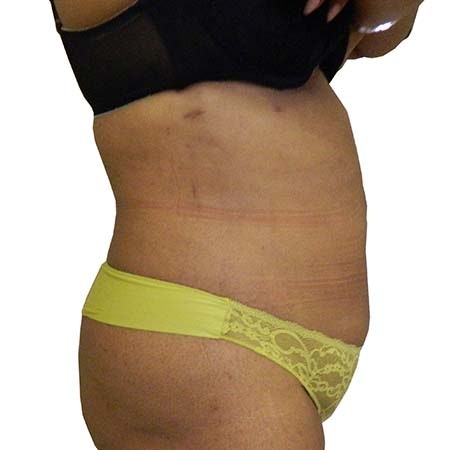 Liposuction patient 1 - post-op
