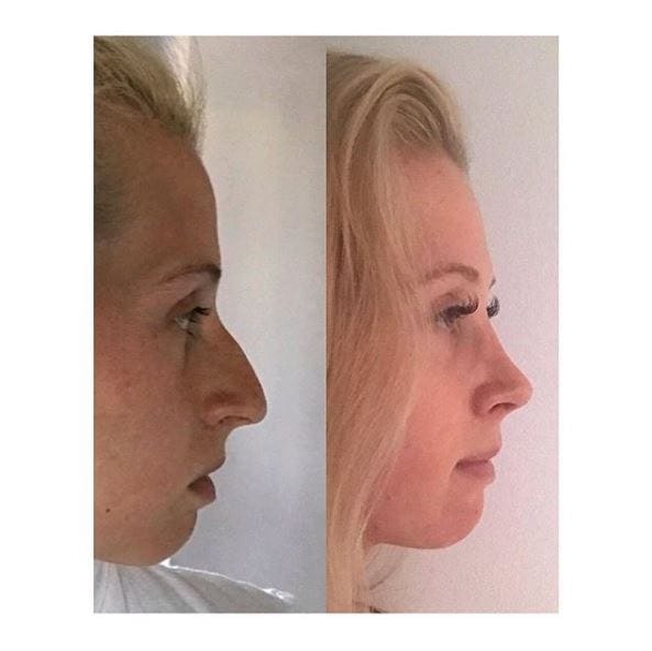 Nose reshaping at MYA - patient story