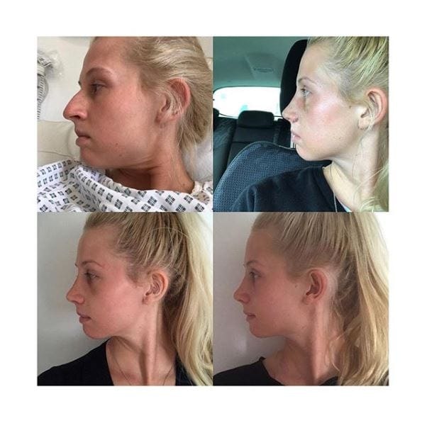 Nose job - MYA Rhinoplasty before and after