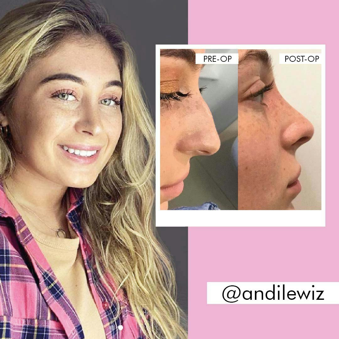 Rhinoplasty patient story before and after @andilewiz