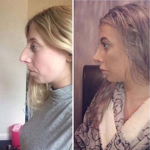 Rhinoplasty before and after at MYA