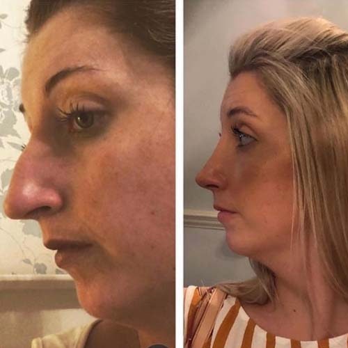 Before and after - Rhinoplasty surgery at MYA