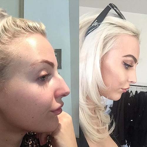 Rhinoplasty surgery before and after