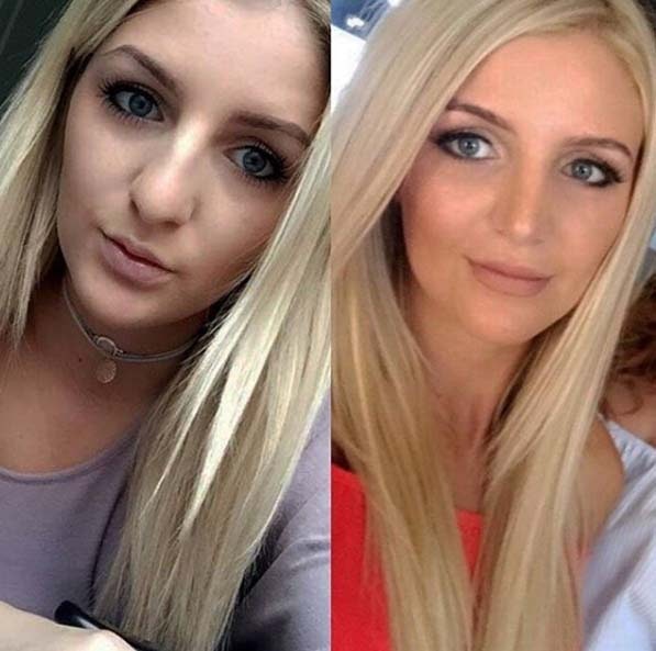 Rhinoplasty patient story - nose job before and after nose job