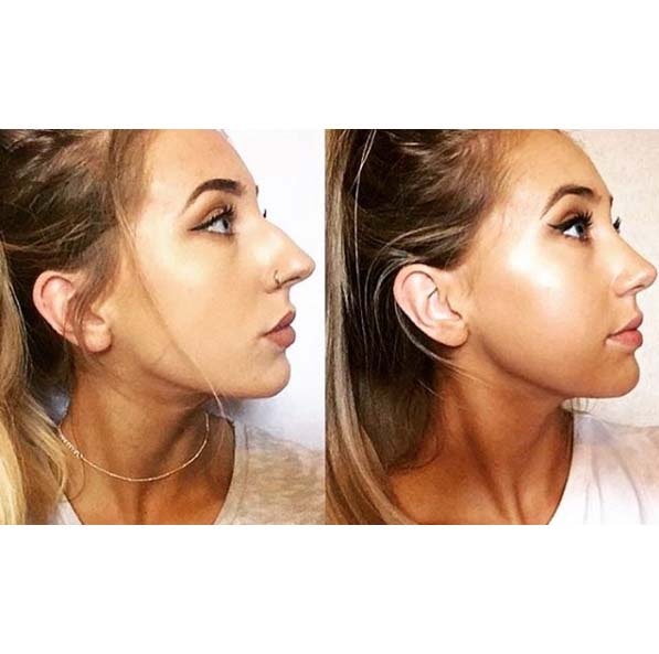 Nose job before and after - rhinoplasty procedure at MYA