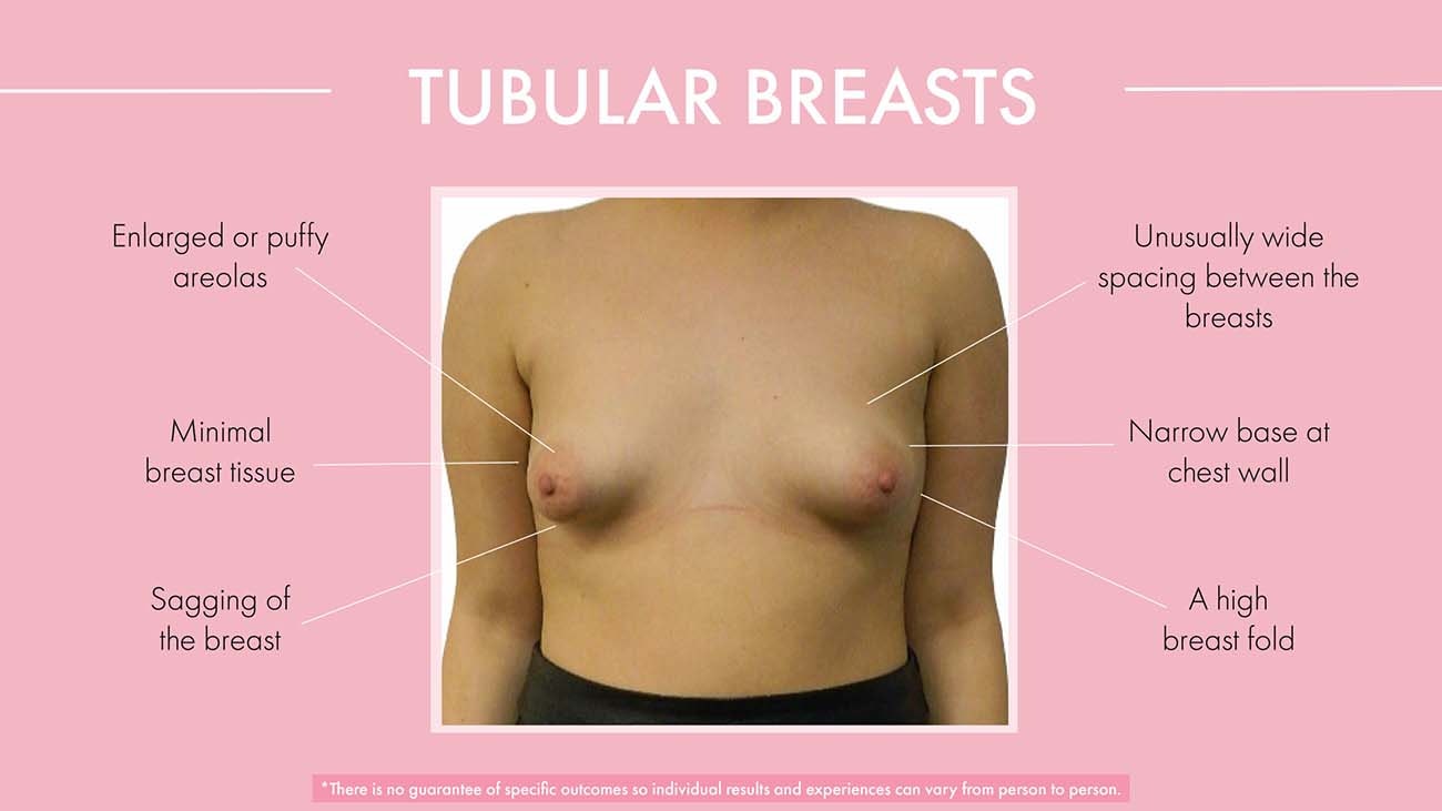 Tubular breasts diagram