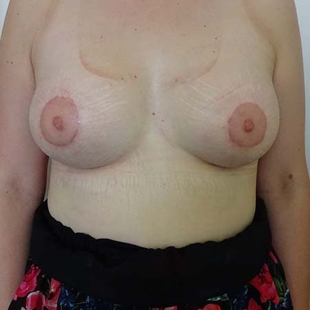 Tubular breasts patient 7 - post-op