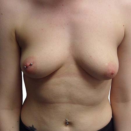 Tubular breasts patient 5 - pre-op