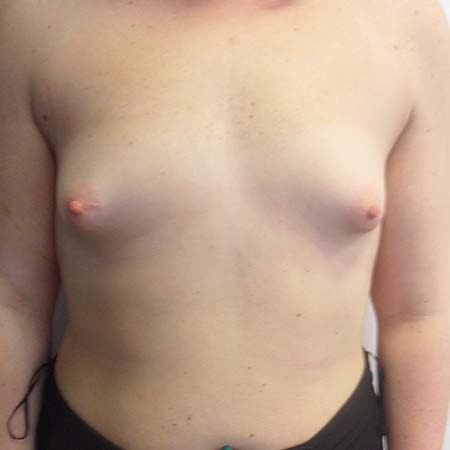 Tubular breasts patient 4 - pre-op