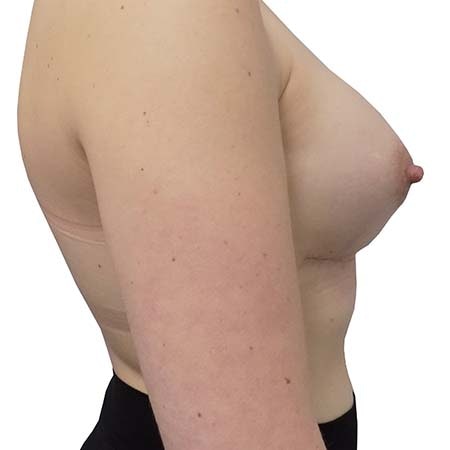 Tubular breasts patient 3 - post-op