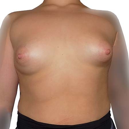 Tubular breasts patient 1 - pre-op