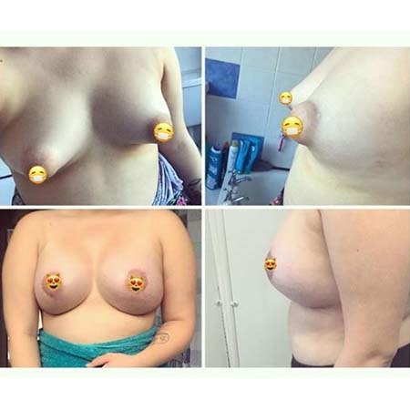 Tubular breasts patient story
