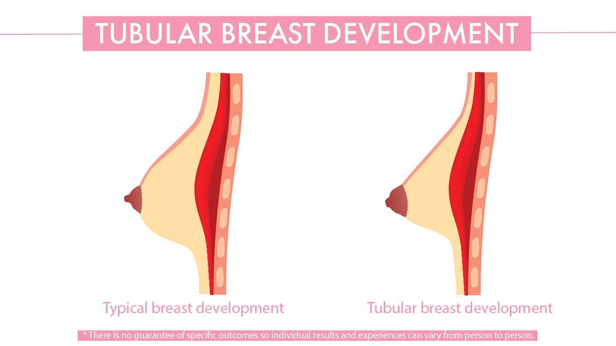 Tubular breasts development diagram