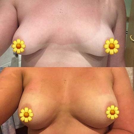 Tubular breasts patient story