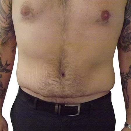 Male tummy tuck results