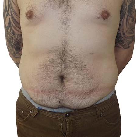 men's tummy tuck before and after
