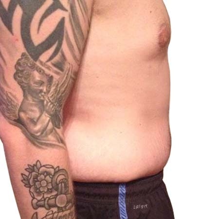 Male tummy tuck surgery results